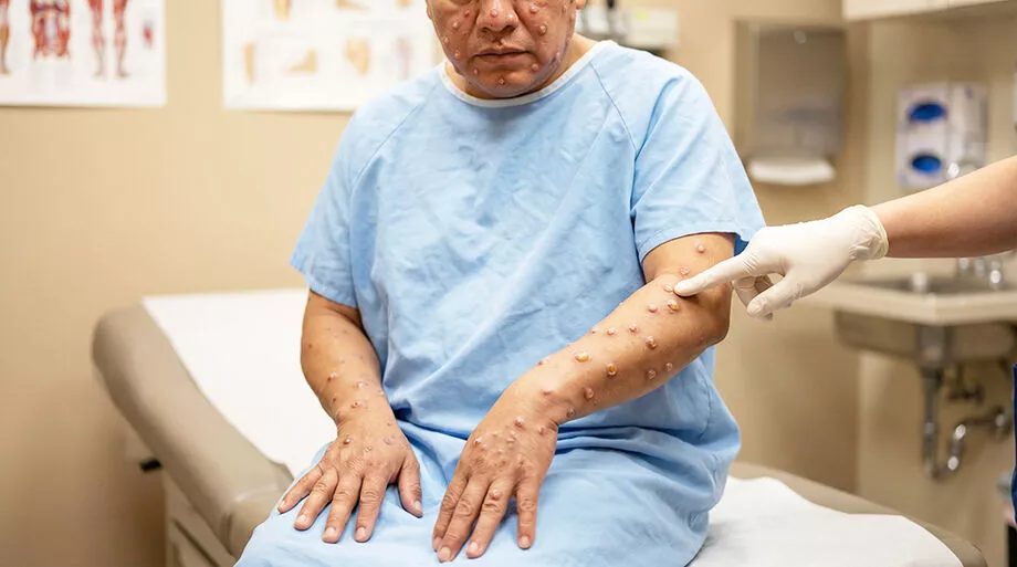 Profissional de saúde analisa amostras de mpox em laboratório; OMS reconheceu nova cepa recombinante do vírus, mas manteve risco baixo para a população em geral. - (Foto: Imagem Ilustrativa/A Critica)